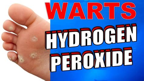 Does hydrogen peroxide kill warts. Hydrogen peroxide was once used to disinfect skin wounds. This is no longer recommended. Research has shown that hydrogen peroxide can irritate or damage the cells needed for healing. Household strength (3%) hydrogen peroxide is sometimes recommended to make dogs and cats vomit if they swallow poison. 