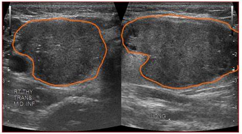 Does hypoechoic thyroid nodule mean cancer.  While hypoechoic nodules ar...