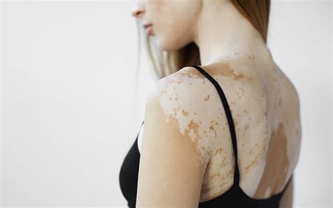 Does hypopigmentation go away. .  <a href=https://samet-liftup.4alabs.com/dgxdtaa/index.php...