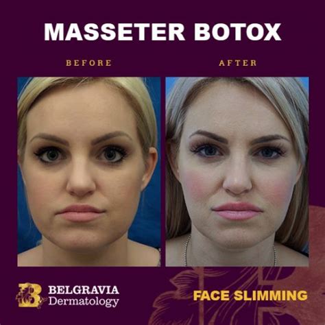 Does insurance cover masseter botox. Things To Know About Does insurance cover masseter botox. 