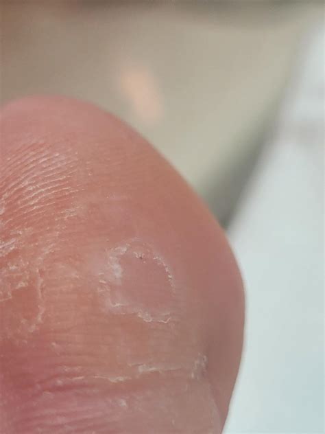 Does it look like these two warts are cleared? : r/Warts