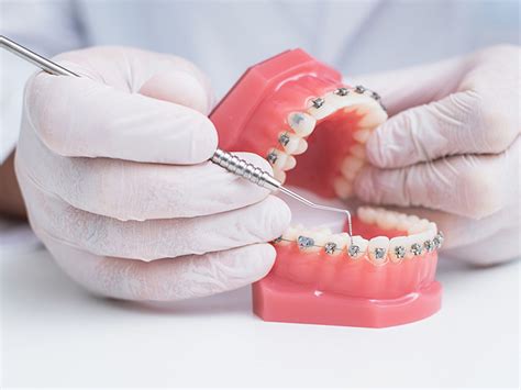 ٧ ربيع الآخر ١٤٤٥ هـ ... Eligibility for Medicaid coverage of braces varies by state. In general, Medicaid will cover orthodontic treatment if it is medically necessary.