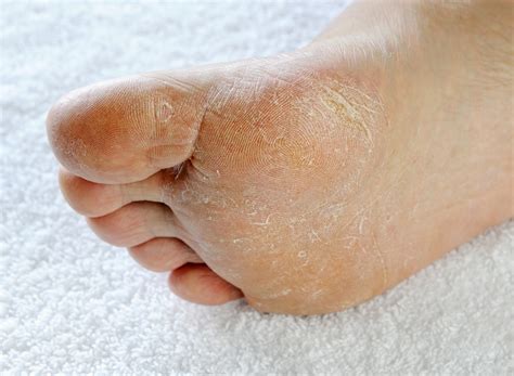 Foot fungus is a condition that can take many forms including athlete’s foot and toenail fungus, all of which are caused by microscopic fungi organisms that make their way into or .... 