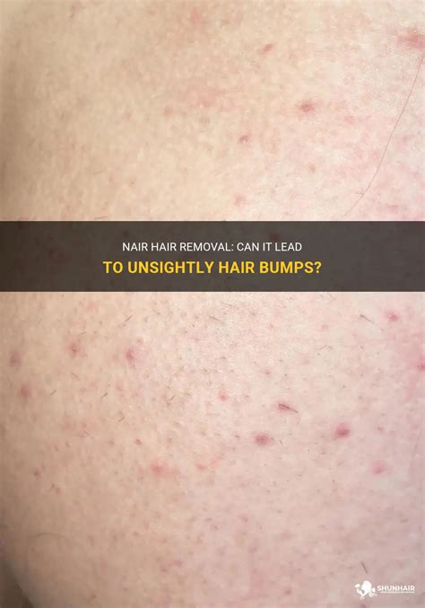 A herpes rash causes small bumps that turn into b