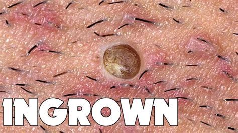  Hold the skin down before pulling/tugging on a hair and you feel close to nothing. TLDR; Shaving causes ingrown hairs. Don't touch it, irritation,itchiness,and swelling will go away. I've been there too sis don't worry. Stop shaving down there and start at home waxing. Trim hairs down first, wax, then pluck leftovers. . 