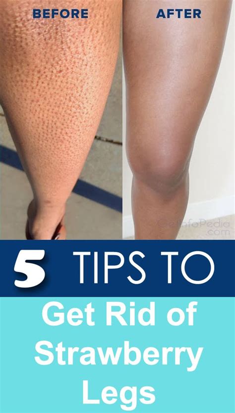 They can appear due to improper hygiene or underlying medical conditions. Most causes can be easily treated and prevented. Here are the most common reasons for strawberry legs: Shaving. Shaving with an old, dull razor or without the proper shaving cream causes razor burns, ingrown hairs, and infections. Folliculitis.. 
