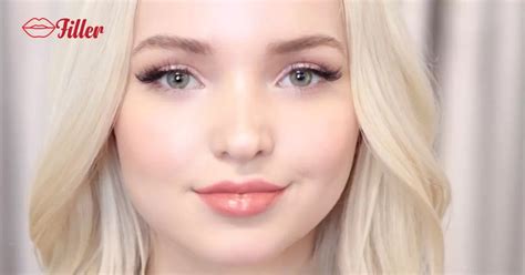 Dove Cameron has been open about her lip filler surgery, and she's not ashamed of it. The actress has admitted to getting lip fillers done in the past, and she's never done anything to hide her decision from fans. The actress recently revealed that Dove Cameron had lip filler done before and that she would get them again in the future.. 
