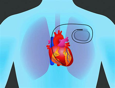 Don’t fear pacemakers - Harvard Health