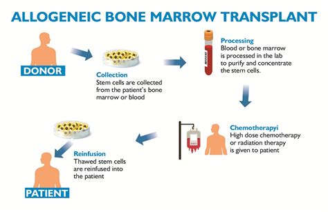 Donating Bone Marrow Procedure Benefits Risks and FAQs