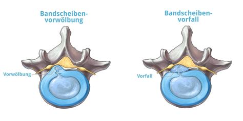 Dorsale Protrusion: Ursachen, Anzeichen und Behandlung