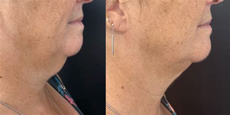 Double Chin Removal, Injections & Treatment - Australian Laser