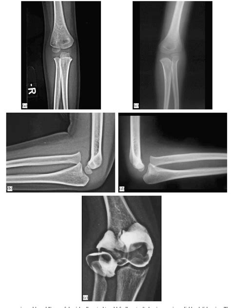 Double ulnar osteomy for the treatment of congenital radial head ...