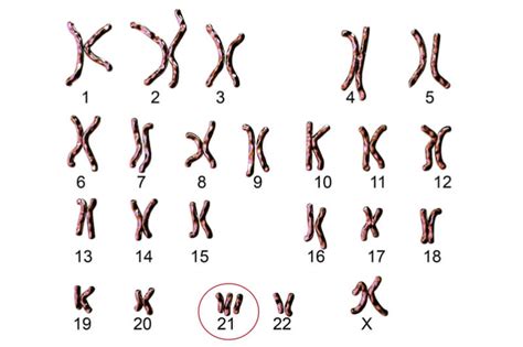 Down Syndrome (tri21) - biologie - biologie.startpagina.nl