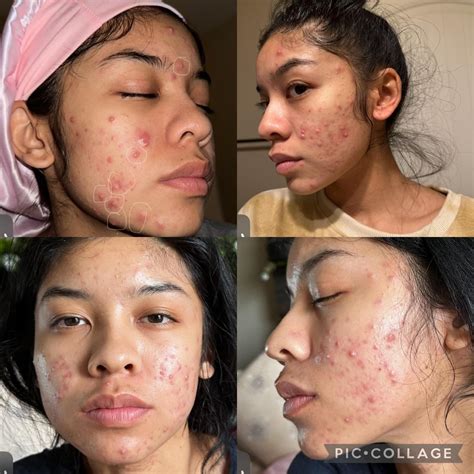 Doxycycline for acne before and after.  Photosensitivity 2.  Usually the first choice for tre...