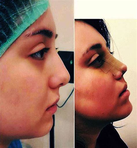 Dr Hamidreza Hosnani, Rhinoplasty in Iran - Blog