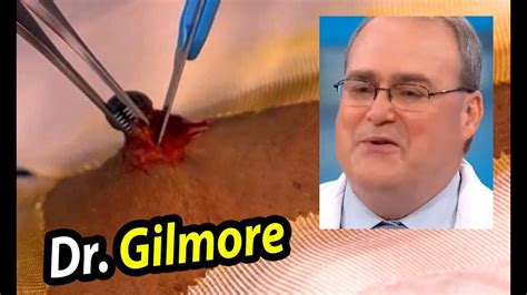Dr john gilmore most recent pimple popping. 18 Views. 0 Likes. July 25, 2018. Popping Videos. By Admin. 0 Comments. #Latest #Gilmore #Hospital #Update #Standing. (Visited 18 times, 1 visits today) documentary dr gilmore dr gilmore neck health health update john gilmore post op john gilmore update medical news update patient science what happened to dr. gilmore. 
