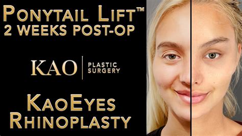 In this Kao Plastic Surgery before and after video we look at the Ponytail Lift Type II with KaoEyes.With two tiny incisions in the temple scalp on each side...
