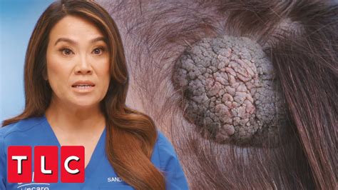 In her latest Instagram video, Dr. Pimple Popper harvested a rare growth from her patient's cheek. She used scissors to cut out what looked like a cauliflower head from the surface of the skin. Dr .... 
