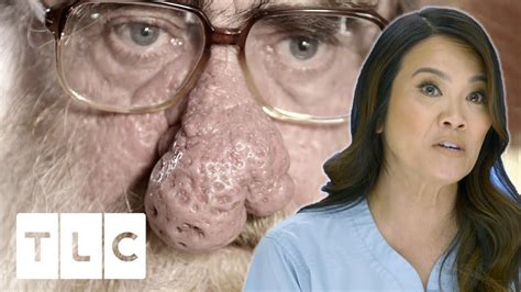 Dr pimple popper rhinophyma. Dr Lee helps Noelle leave her teenage self behind and transform into the woman she is today. She also tries to remove a lump that Taylor has had since she wa... 