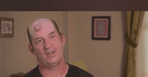 Jason aus St. Louis hat einen Tumor im Nacken, der so groß ist wie ein Softball. Vor 13 Jahren bemerkte er eine kleine Beule am Hinterkopf, die langsam wuchs.... 