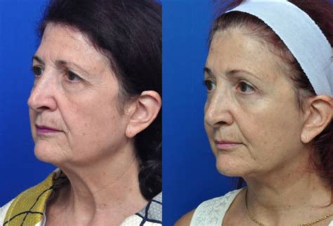 Dr. Garcia 32256 » Eyelid Surgery: Cost, Photos, Rewiews, Q&A