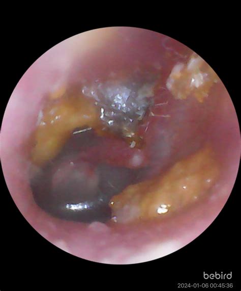 Dr. says my eardrum is black. : r/medical_advice - Reddit