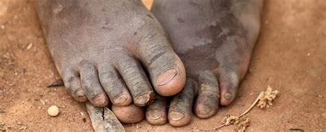 Dracunculiasis (Guinea-worm disease) - WHO