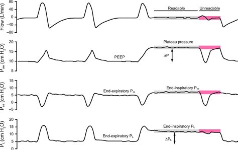 Driving Pressure and Transpulmonary Pressure