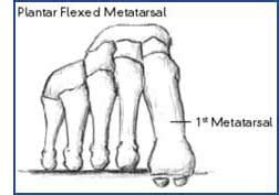 Dropped Metatarsal Heads - The Foot and Ankle Clinic