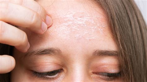 Dry Scaly Skin - Symptoms, Causes, Treatments