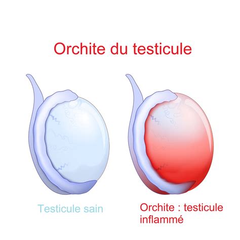 Du tubercule du testicule et de l'orchite tuberculeuse. - A guide for using the cricket in times square in the classroom.