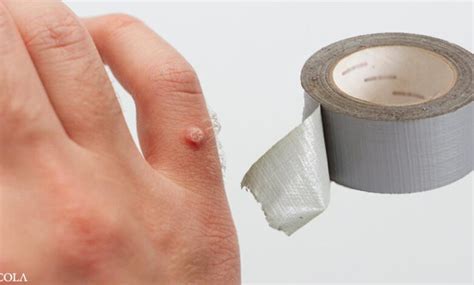 Duct tape for warts in children - PMC - National Center for ...