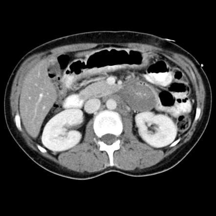 Duodenum Hematoma - an overview ScienceDirect Topics