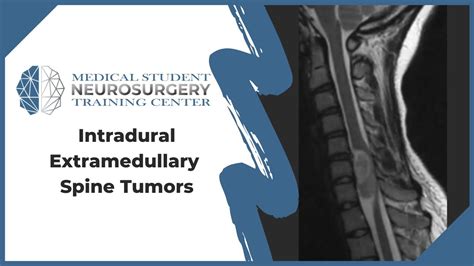 Dural Closure for MIS Intradural Spine Tumor Resection VuMedi