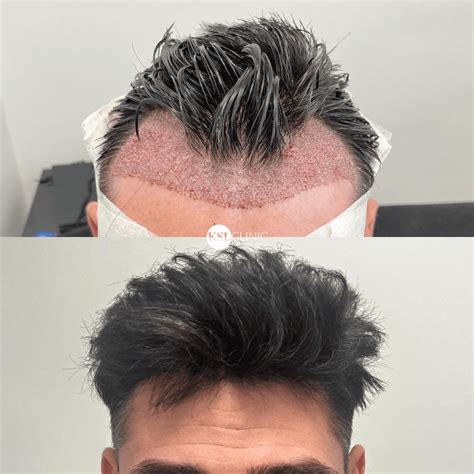 Dyeing After Hair Transplant ReHair Istanbul