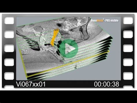 DynaMesh® MRI - Animation: MRI Reconstruction with …