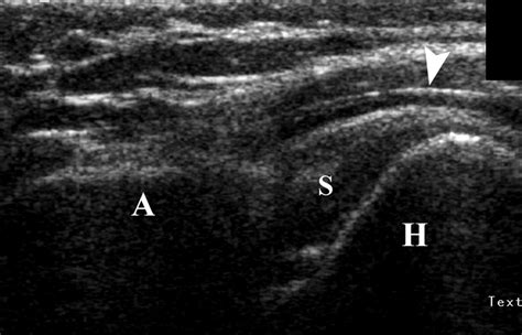 Dynamic Sonography Evaluation of Shoulder Impingement …