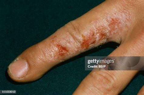 Dyshidrosis Photos and Premium High Res Pictures - Getty Images