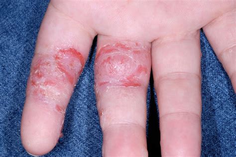 Dyshidrotic eczema (Pompholyx, Vesicular Hand Eczema)