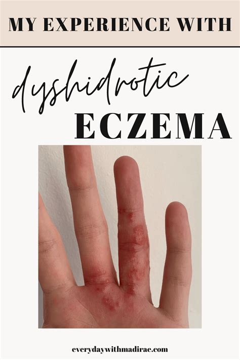 Approach Considerations. In dyshidrotic eczema, typical first-lin