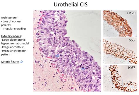 Dysplasia and carcinoma in situ of the urinary bladder