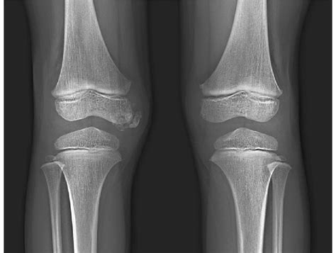 Dysplasia epiphysealis hemimelica Radiology Reference Article ...