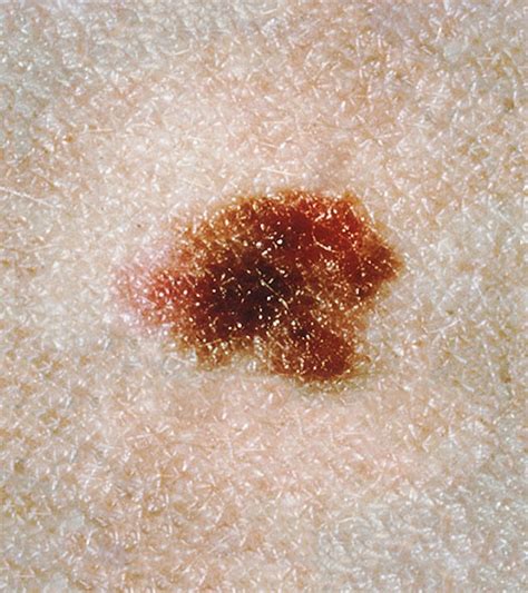 Dysplastic nevus a typical mole or typical myth. - 1974 johnson 70 hp owners manual.