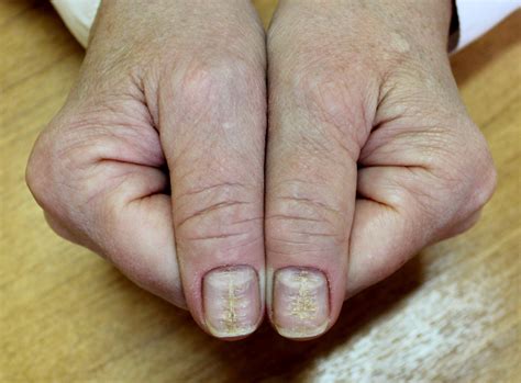 Dystrophic nails icd 10. M20.10 - M20.12: Hallux valgus (acquired), unspecified foot [covered for capsular or bone surgery only] M21.611 - M21.629: Bunion: Debridement of mycotic nails: CPT codes covered if selection criteria are met: 11719: Trimming of non-dystrophic nails, any number: 11720: Debridement of nail(s) by any method(s); one to five: 11721: six or more 