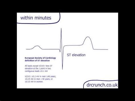 ECG/EKG changes in MI in 30 seconds - YouTube