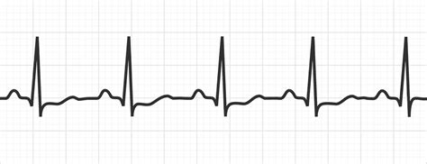 ECG Disease Patterns - MedSchool