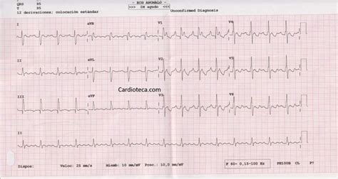 ECG de hipertensión