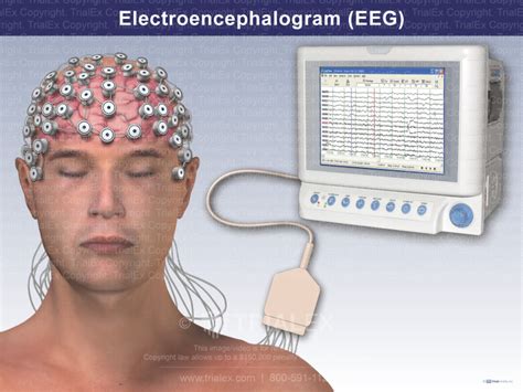 EEG (electroencephalogram) - Mayo Clinic - coolestguyplanet.net