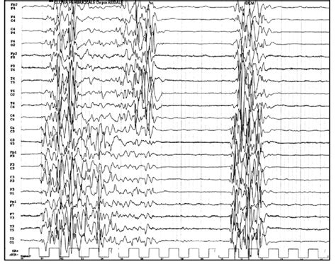 EEG pattern of burst suppression. Download Scientific Diagram