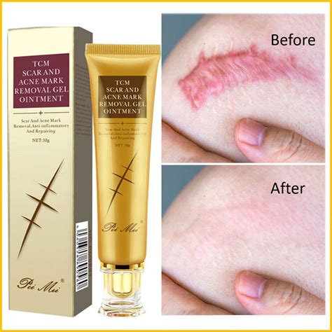 EFFECTIVE WAYS OF REMOVING SCARS ON LEGS - Cosmetics.lk